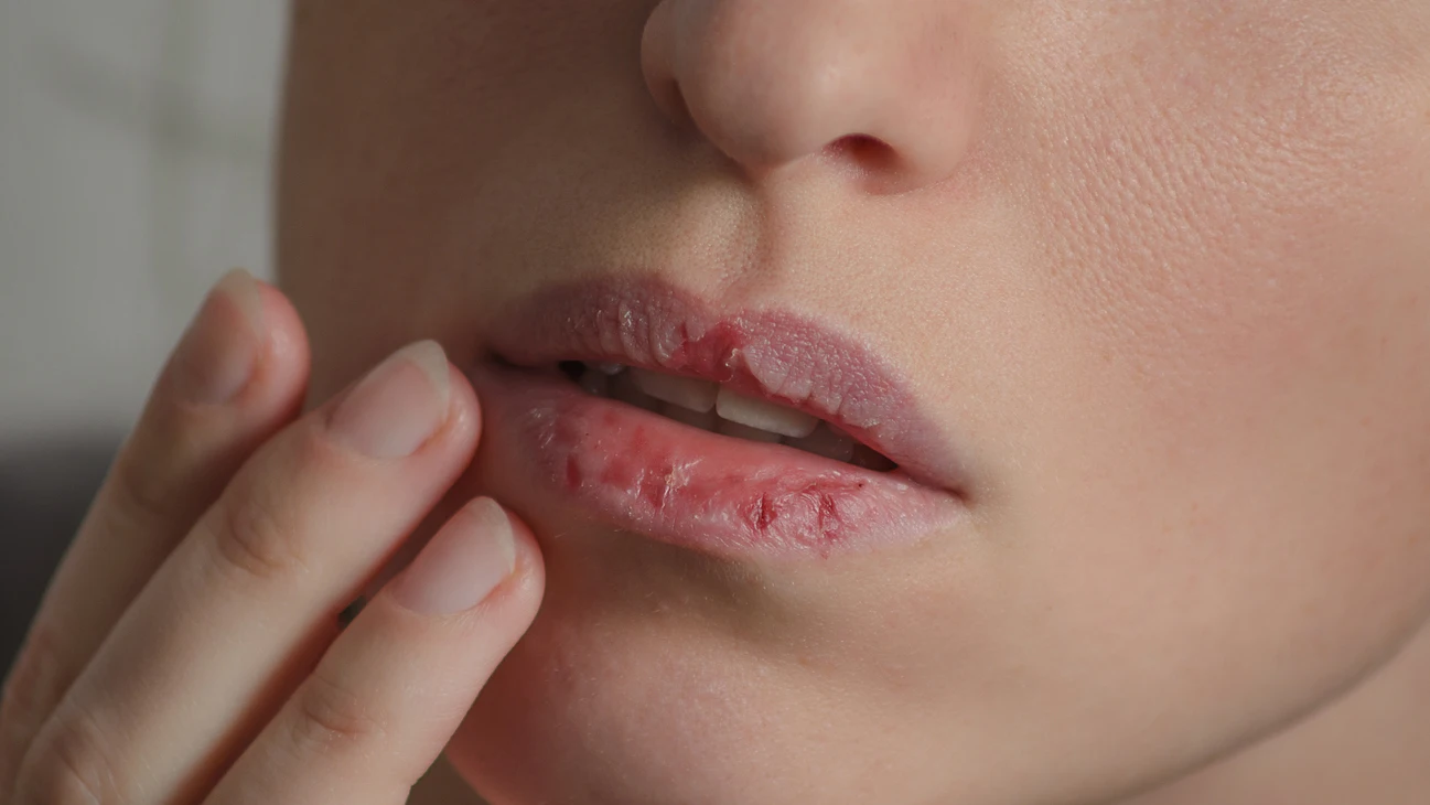 Labios secos