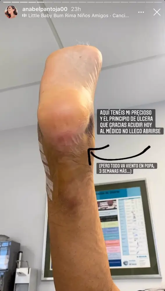 Así está el pie de Anabel Pantoja tras sufrir un principio de úlcera