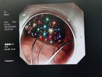 Imagen de las bolas en el estómago del niño