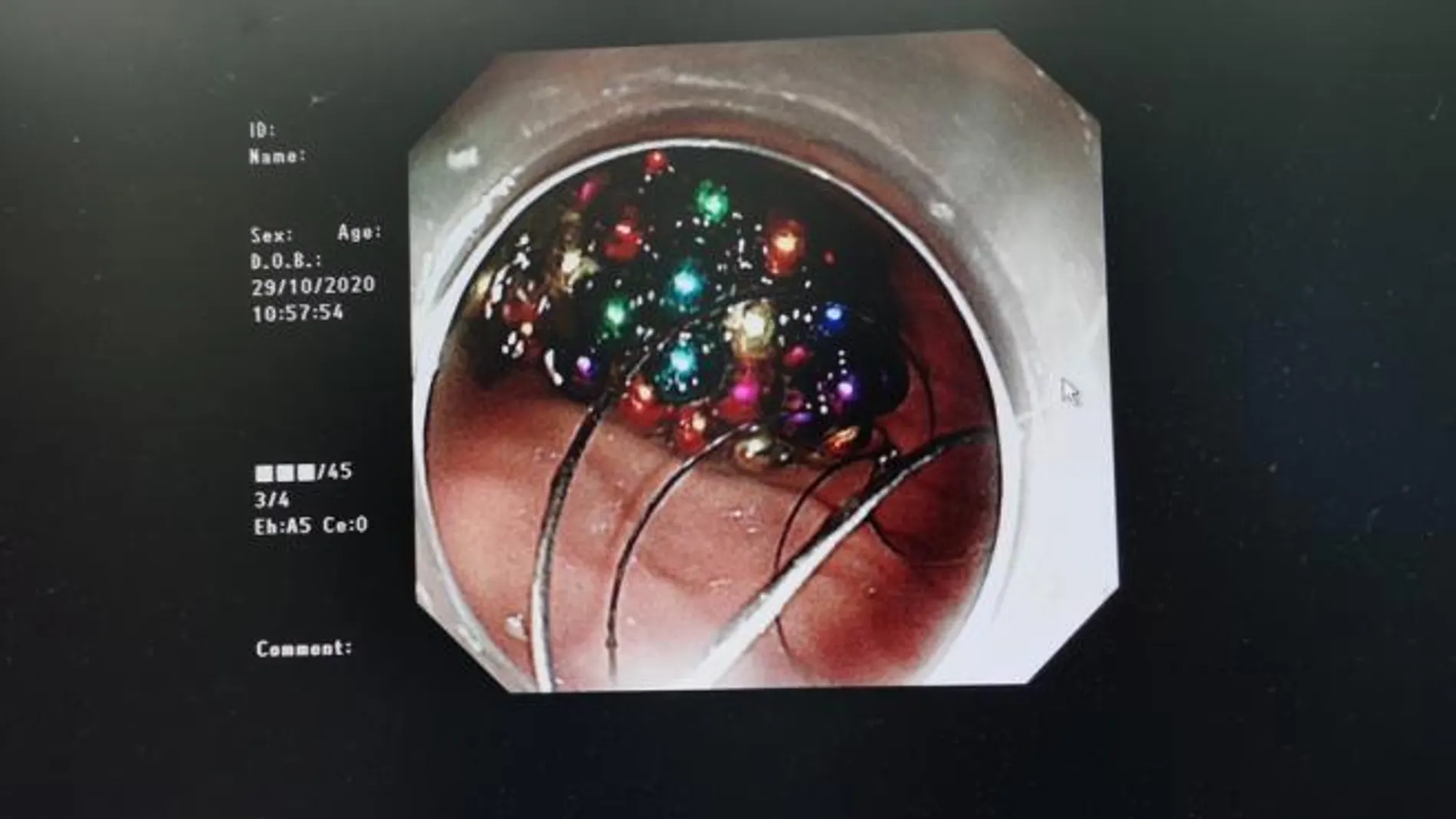 Imagen de las bolas en el estómago del niño Imagen de las bolas en el estómago del niño