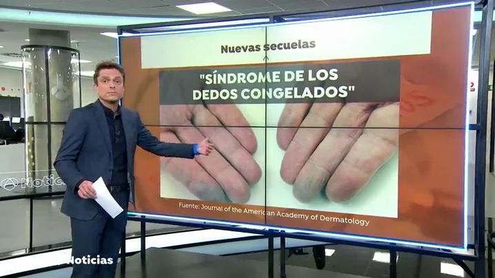 Descubren nuevas secuelas del coronavirus como el 'síndrome de los dedos congelados' o la caída del cabello Descubren nuevas secuelas del coronavirus como el 'síndrome de los dedos congelados' o la caída del cabello