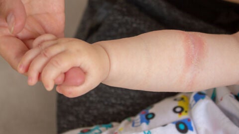 Dermatitis
