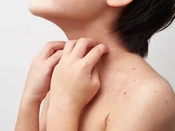 Dermatitis atópica Dermatitis atópica