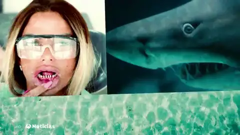 Dientes de tiburón, la última moda entre algunos 'influencers' Dientes de tiburón, la última moda entre algunos 'influencers'