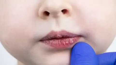 Labios secos