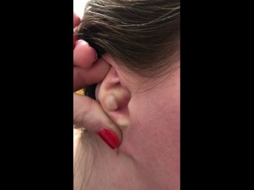 VÍDEO: Una mujer estadounidense explota un gigantesco grano dentro de su oreja