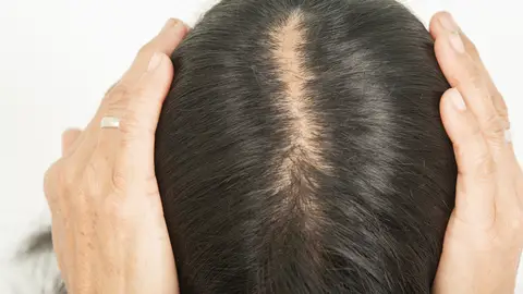 Alopecia Alopecia