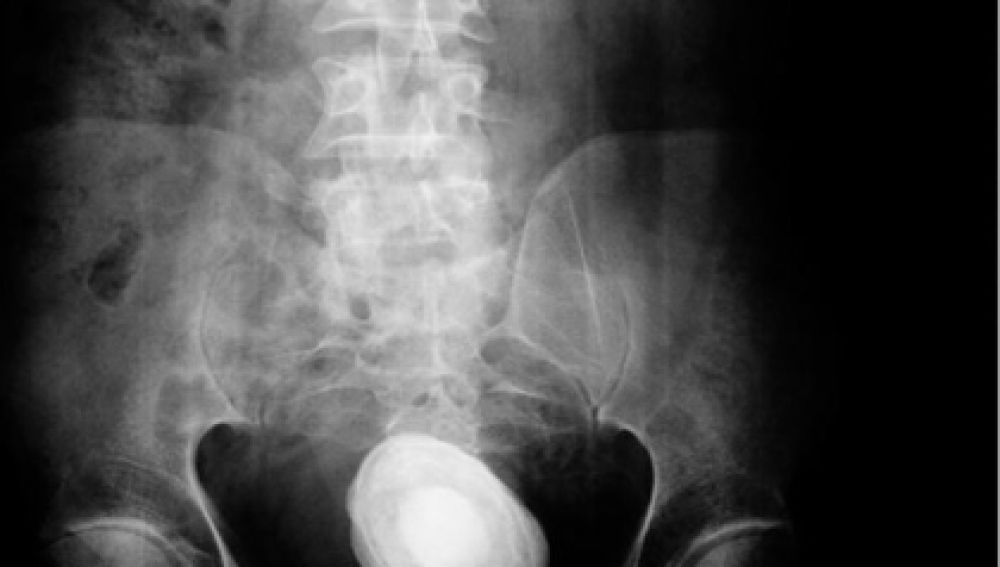 Ingresa en el hospital por fuerte dolor abdominal y le extraen una piedra de medio kilo en la vejiga