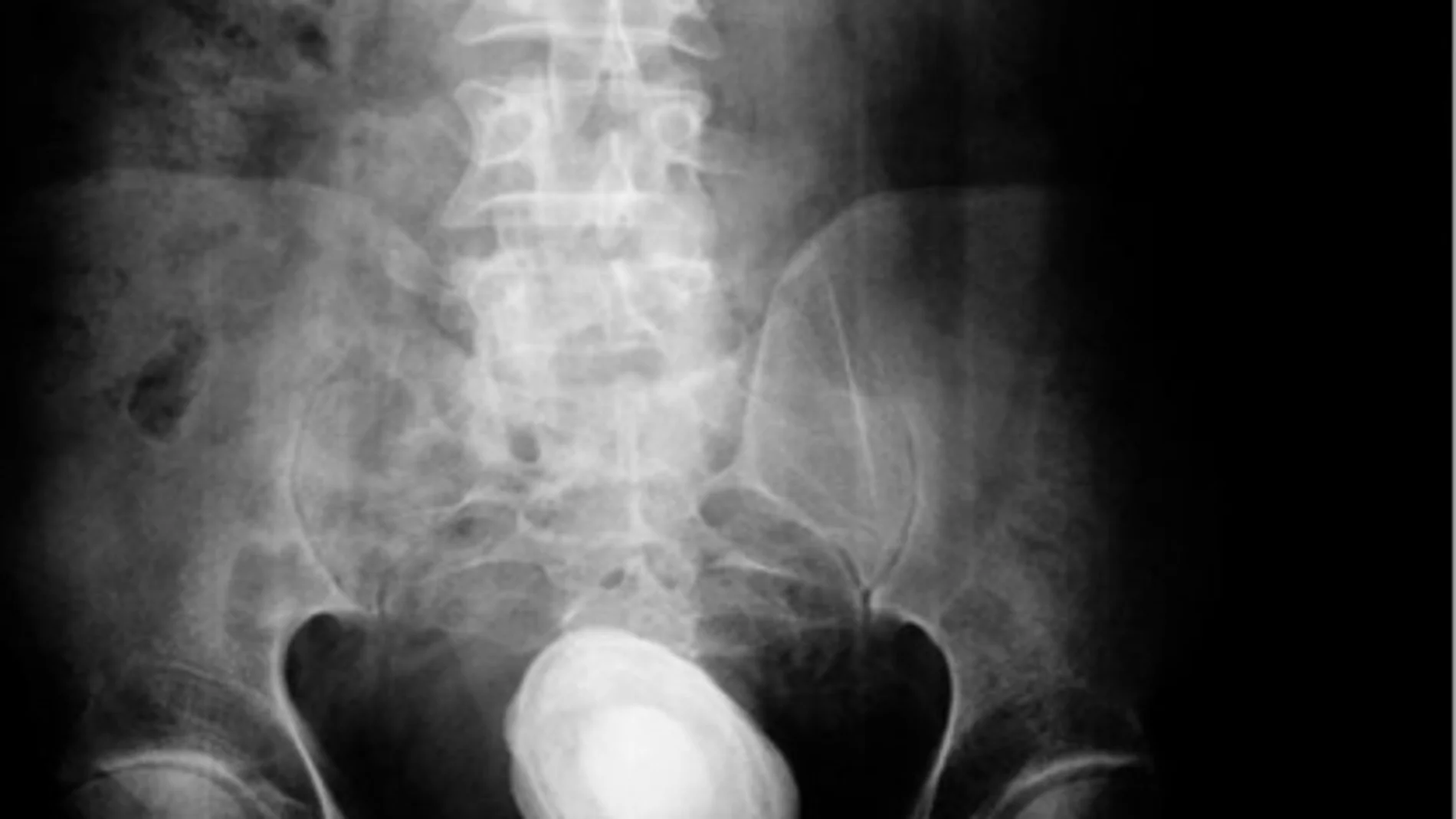 Ingresa en el hospital por fuerte dolor abdominal y le extraen una piedra de medio kilo en la vejiga Ingresa en el hospital por fuerte dolor abdominal y le extraen una piedra de medio kilo en la vejiga