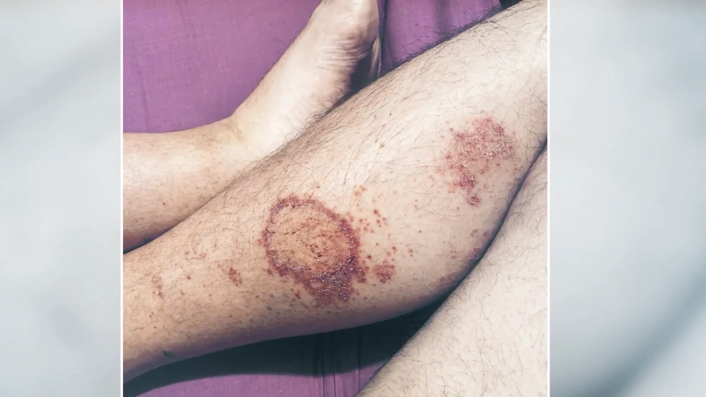 Un hombre se infecta hasta 3 veces de coronavirus en menos de un año Coronavirus