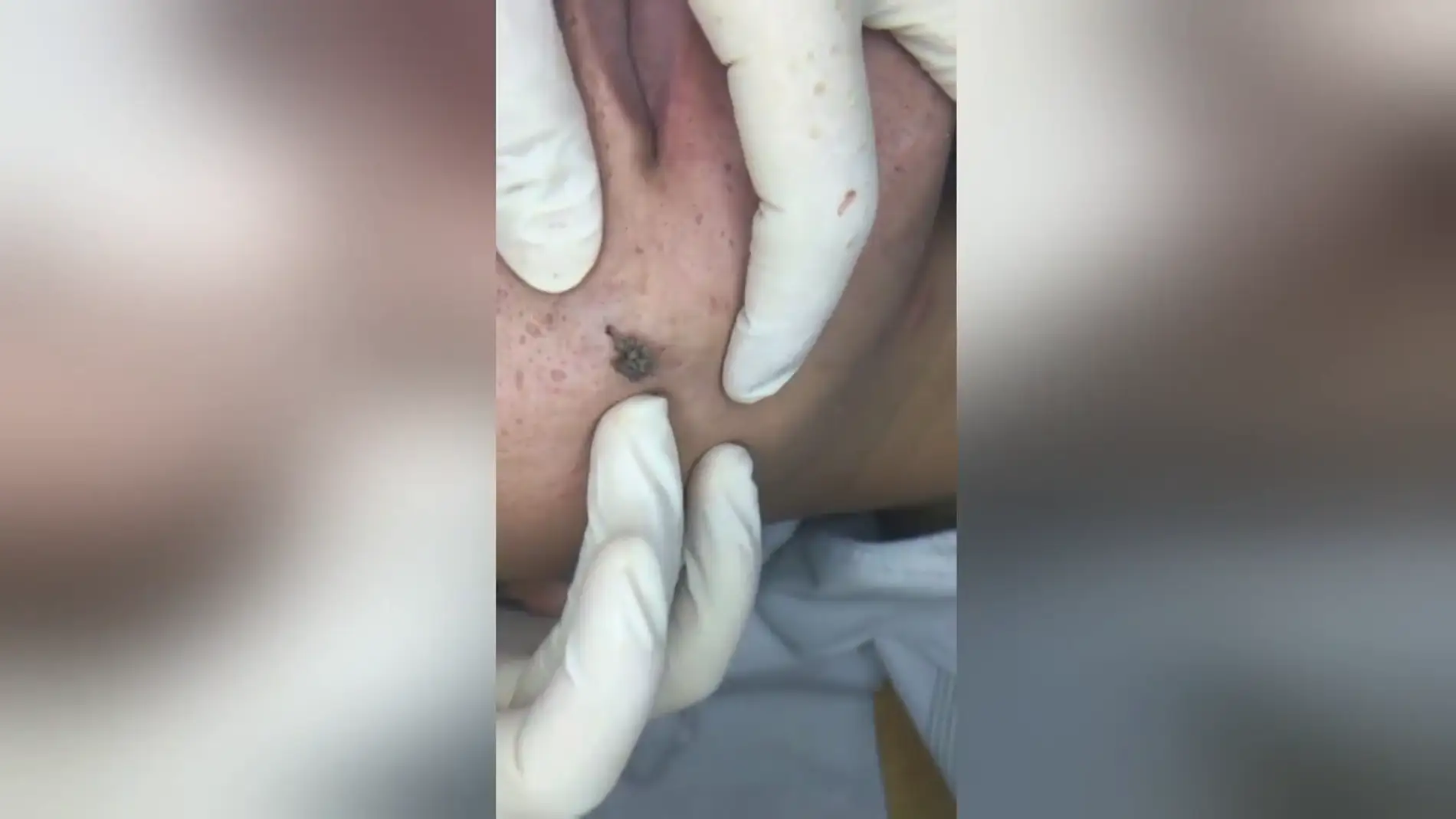 VÍDEO: Un dermatólogo revienta un punto negro gigante en la cara de un paciente