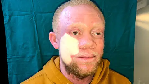 Reginaldo Carlos, operación Pedro Cavadas Reginaldo Carlos, operación Pedro Cavadas