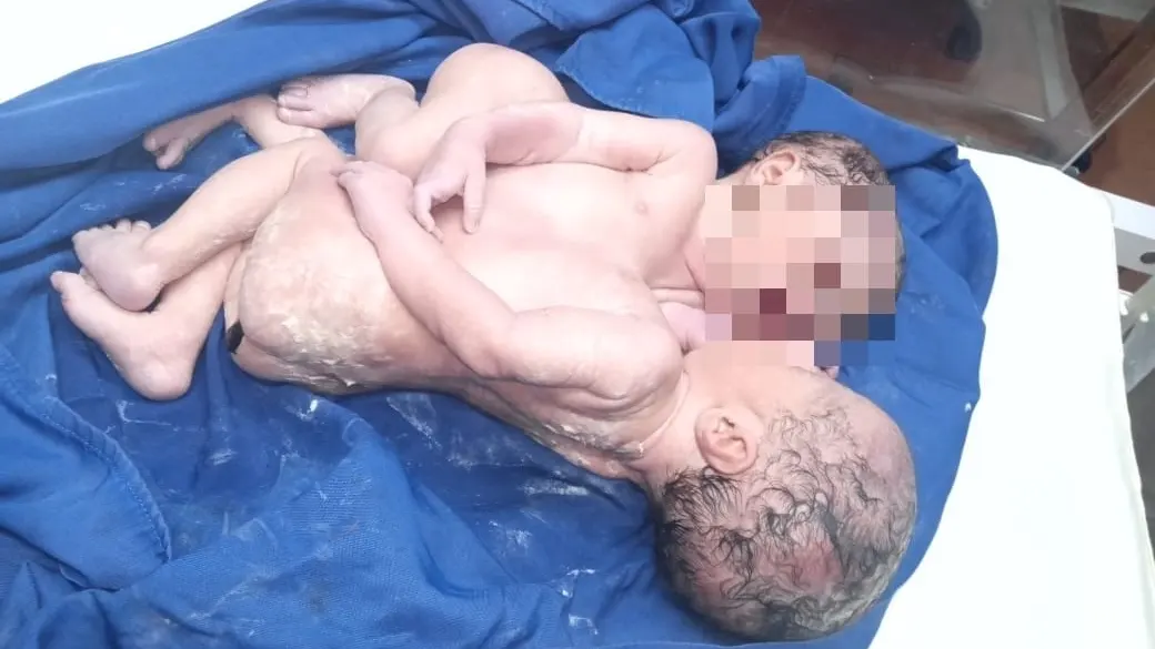 Dos bebés siameses nacidos en Marruecos Dos bebés siameses nacidos en Marruecos