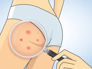 Granitos en los glúteos Granitos en los glúteos