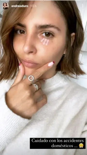 Andrea Duro muestra su herida cerca del ojo Andrea Duro muestra su herida cerca del ojo