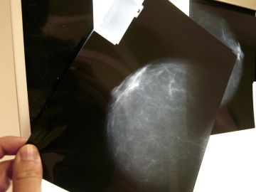Avances en los tratamientos del cáncer de mama: no se necesitará quimioterapia 