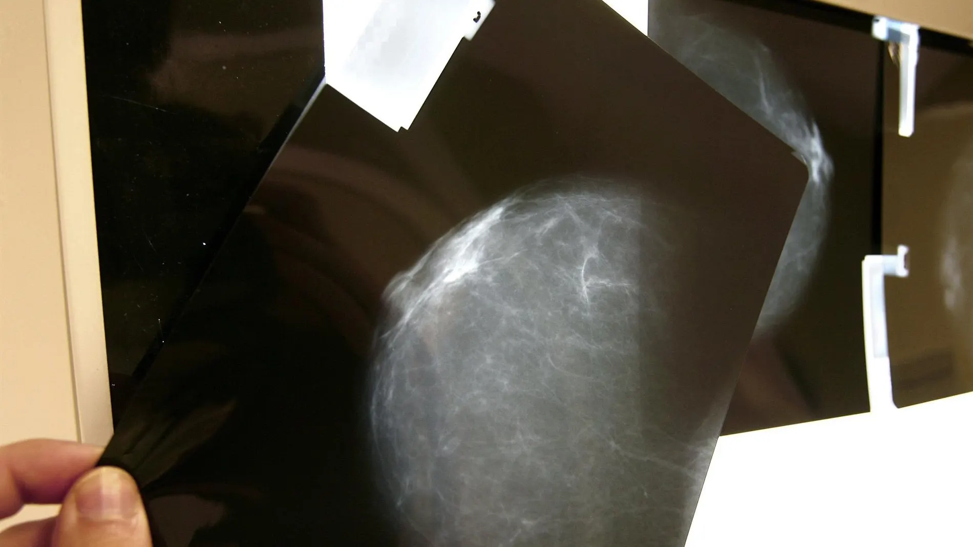 Omomyc podría frenar la metástasis en el cáncer de mama