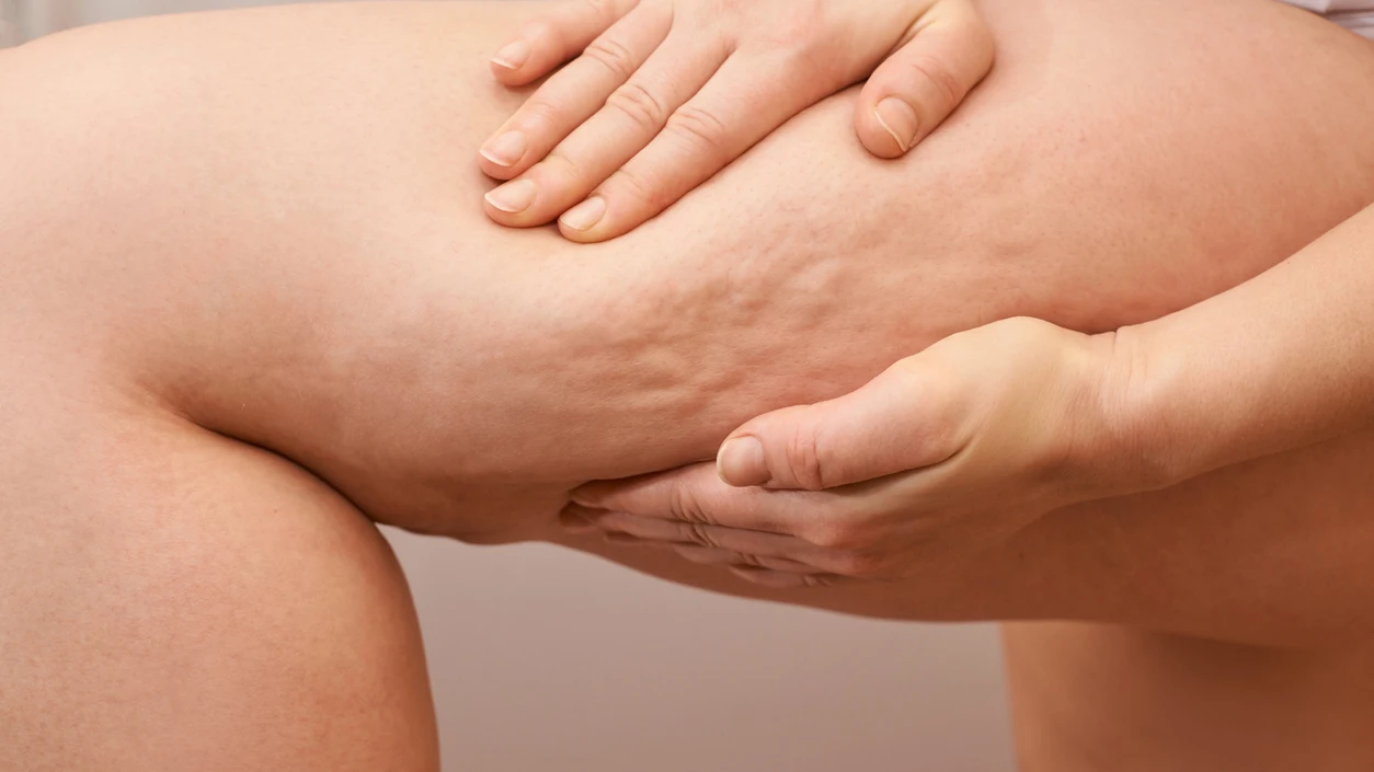 Celulitis Celulitis