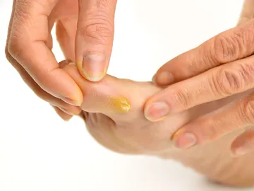 ¿Tienes callos en los pies? Esto es lo que tienes que hacer (y lo que no) ¿Tienes callos en los pies? Esto es lo que tienes que hacer (y lo que no)