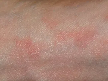 ¿Se ha producido un aumento de contagios de sarna en España tras la pandemia de coronavirus? ¿Se ha producido un aumento de contagios de sarna en España tras la pandemia de coronavirus?