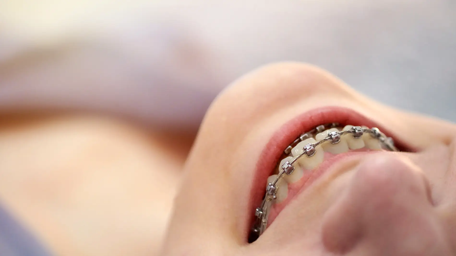 Brackets
