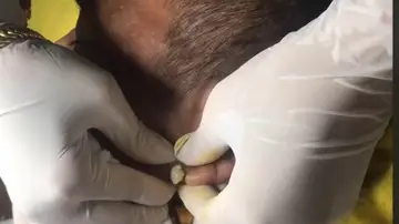 VÍDEO: Una dermatóloga explota un gigantesco grano que llevaba 8 años creciendo en la oreja de un paciente