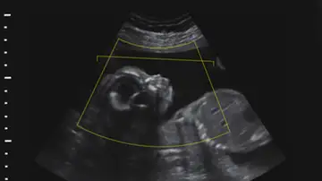 Demandan a una clínica de fertilidad por intercambiar por error los embriones de dos parejas