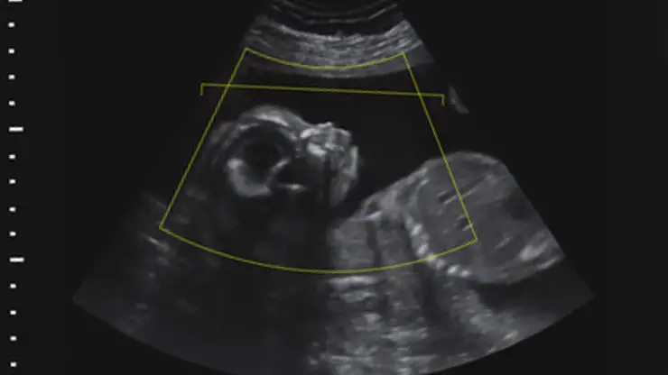 Demandan a una cl&iacute;nica de fertilidad por intercambiar por error los embriones de dos parejas
