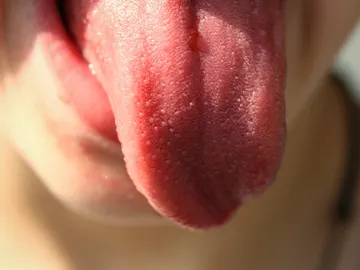 Cómo aliviar las quemaduras de la lengua Cómo aliviar las quemaduras de la lengua