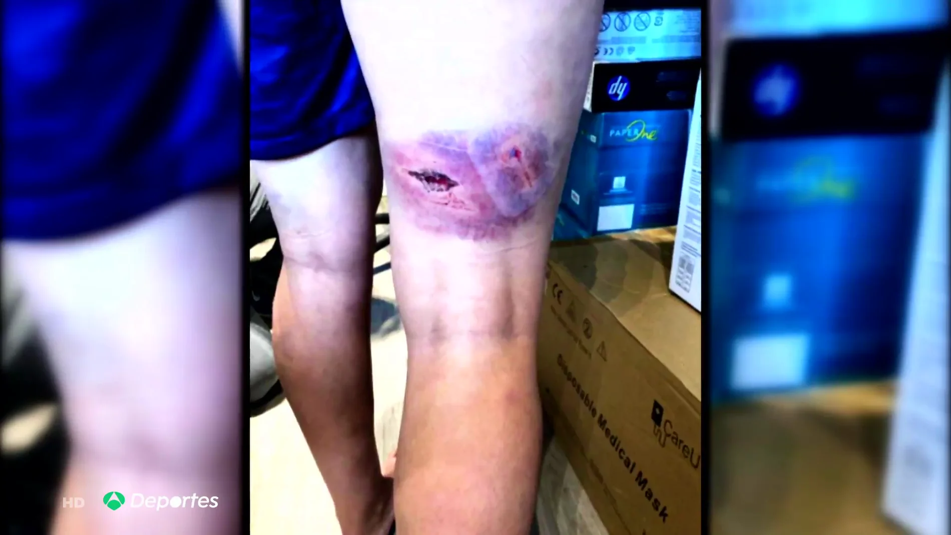 Kheira Hamraoui muestra las terribles heridas tras la paliza que sufrió el pasado 4 de noviembre: "Traté de protegerme"