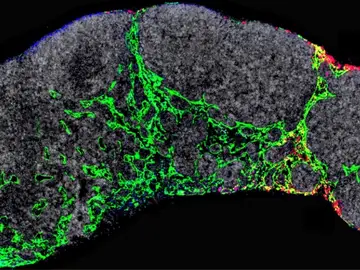 Investigadores españoles descubren un tratamiento que podría ser eficaz contra la metástasis del melanoma Investigadores españoles descubren un tratamiento que podría ser eficaz contra la metástasis del melanoma