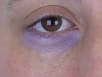 Marcado de ojeras Marcado de ojeras
