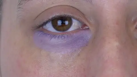 Marcado de ojeras Marcado de ojeras