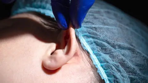 Otoplastia Otoplastia