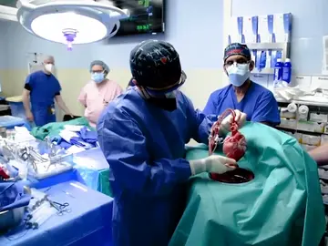 Trasplante de corazón de cerdo Trasplante de corazón de cerdo