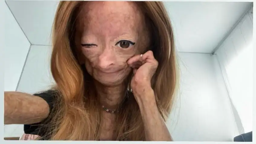 Muere Adalia Rose Williams, la youtuber que inspiró la película de Benjamin Button Muere Adalia Rose Williams, la youtuber que inspiró la película de Benjamin Button