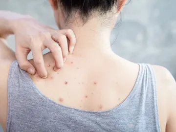 Granos en la espalda Granos en la espalda