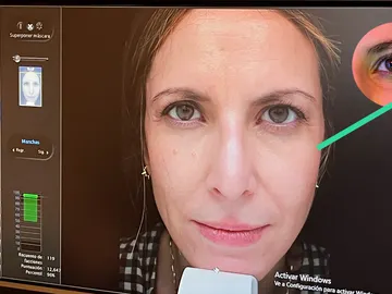 Resultados del tratamiento Symmed Total Face&Neck Resultados del tratamiento Symmed Total Face&Neck