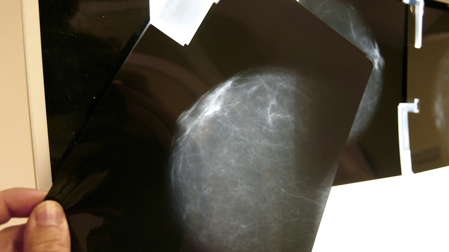 Un nuevo fármaco frena la metástasis de un tipo de cáncer de mama en 3 de cada 4 pacientes