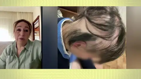 Sufrir de alopecia. Sufrir de alopecia.