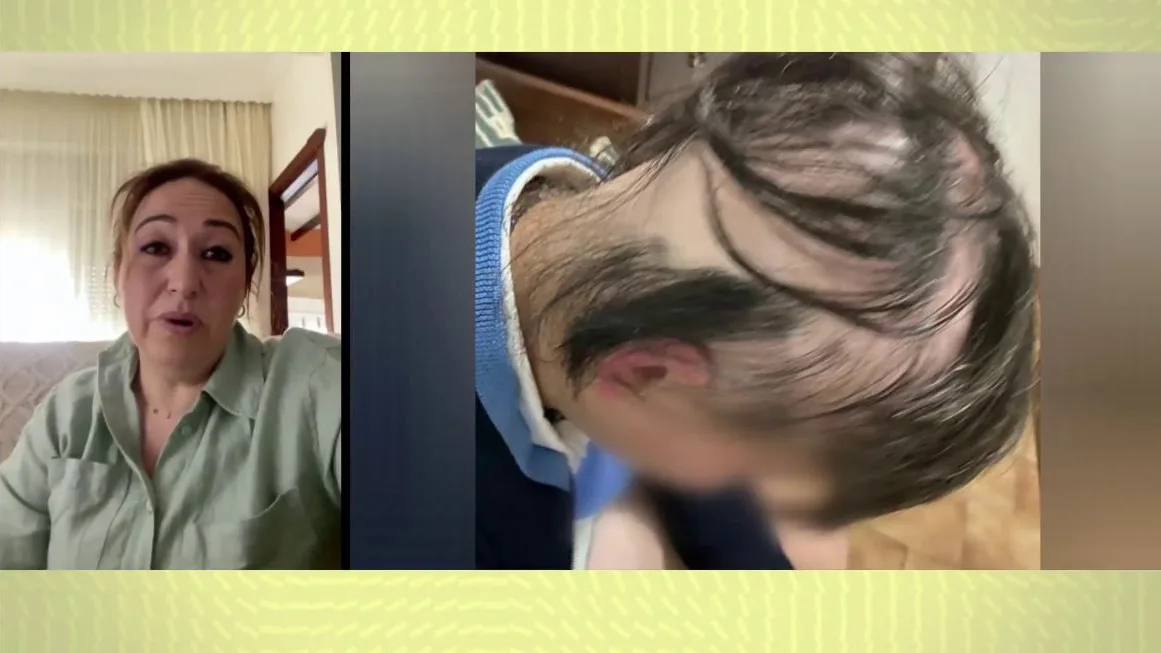 Sufrir de alopecia. Sufrir de alopecia.