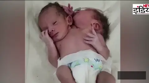 Nace un bebé con dos cabezas, dos corazones y tres brazos Nace un bebé con dos cabezas, dos corazones y tres brazos