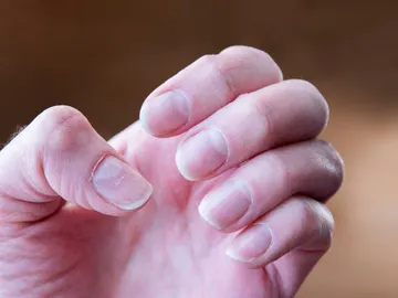 Uñas con manchas. Uñas con manchas.