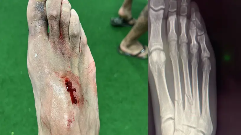 As&iacute; qued&oacute; el pie de Akapo tras la entrada de Hazard