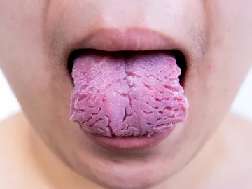 Lengua agrietada Lengua agrietada