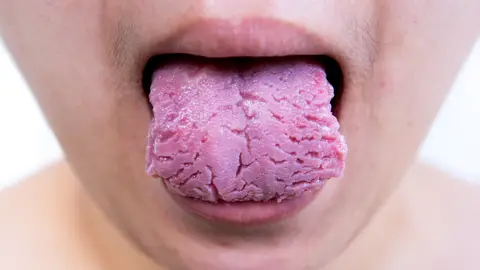 Lengua agrietada Lengua agrietada