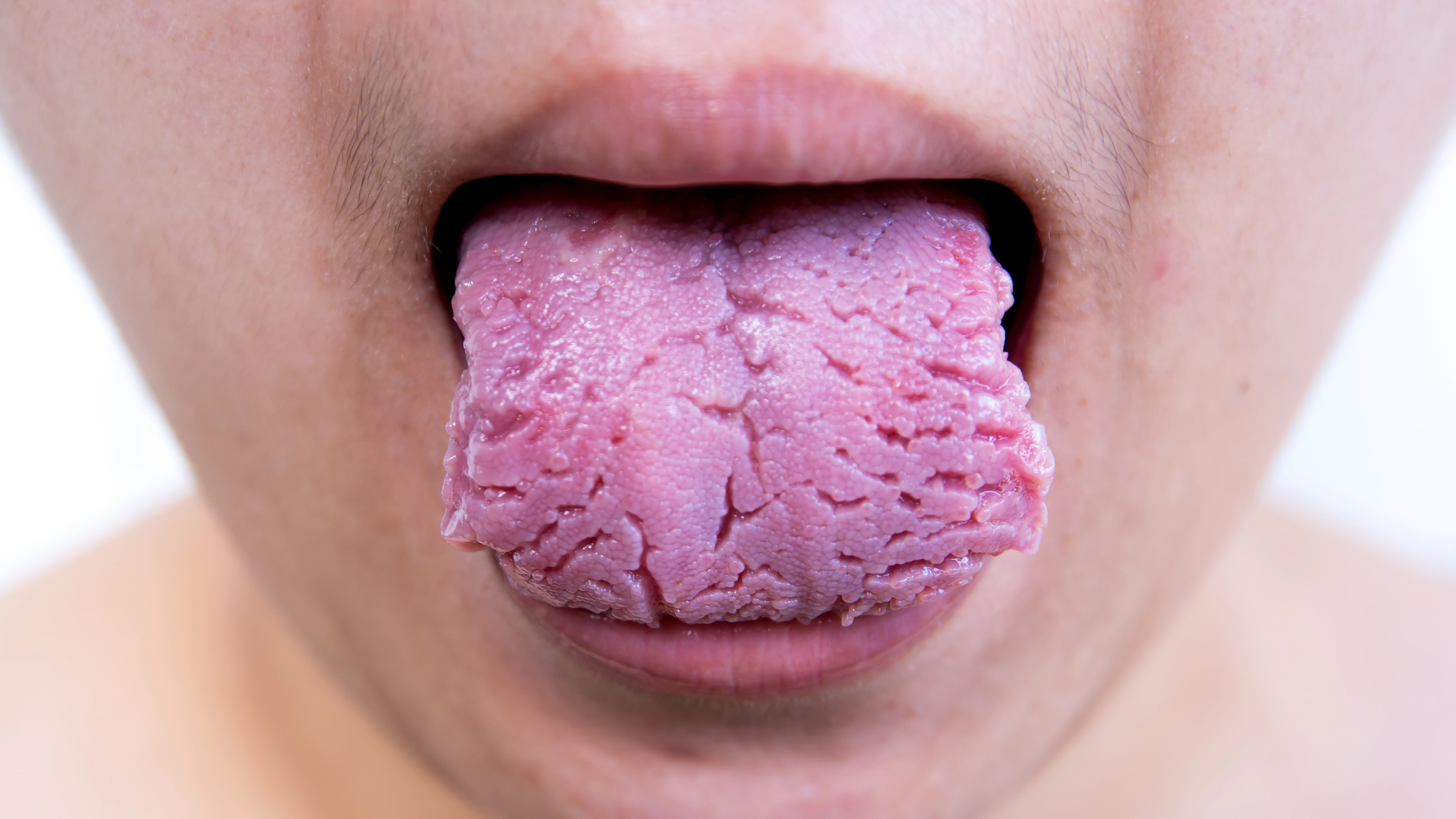 Lengua agrietada Lengua agrietada