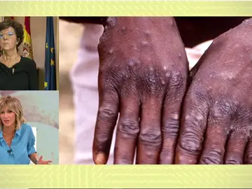 Varicela del mono. Varicela del mono.