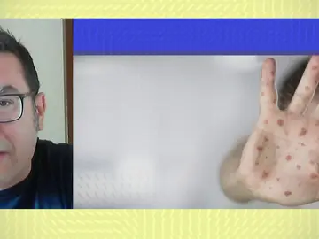 Alerta de la viruela del mono. Alerta de la viruela del mono.