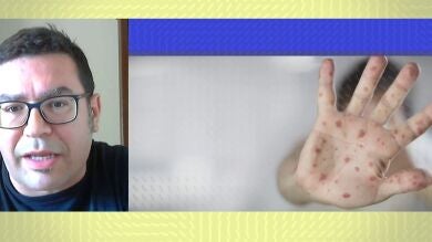 Estanislao Nistal explica el tipo de tratamiento que existe contra la viruela del mono